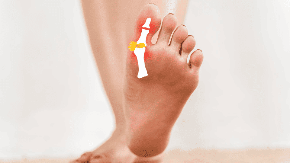 Bunion (Hallux Valgus) Deformity