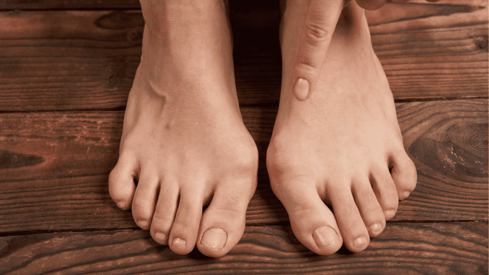Corns, Calluses & Toe Deformities