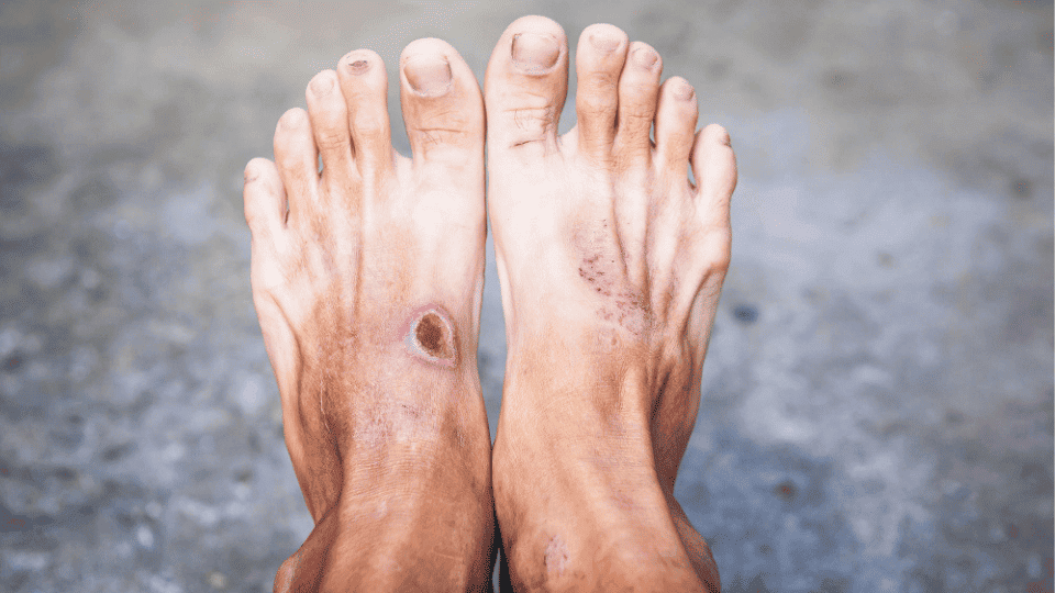 Diabetic & Charcot Foot Reconstruction